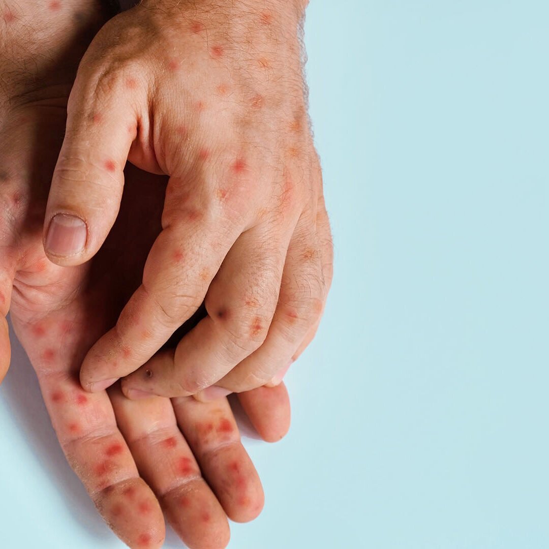 Mpox