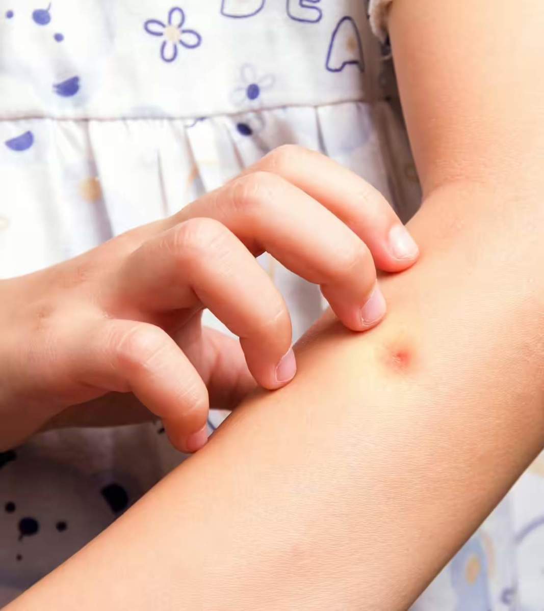 Mosquito Bite