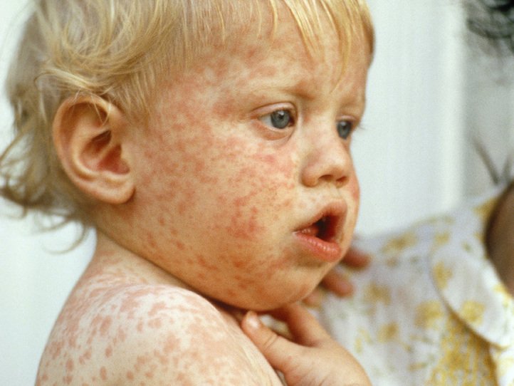 Measles 4x3