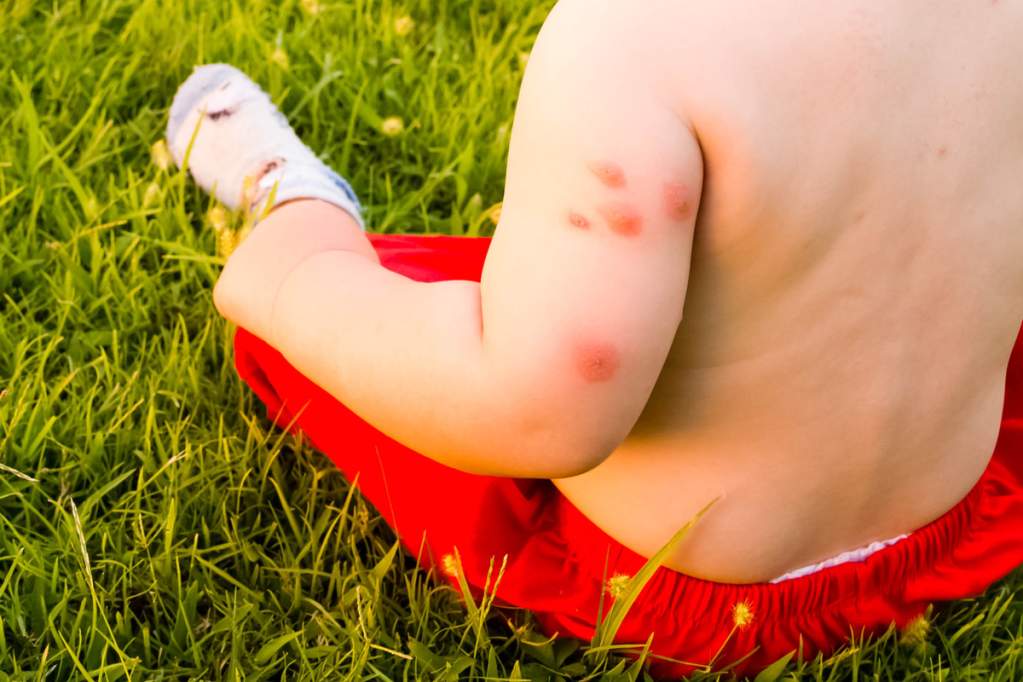 Mosquito Bite1