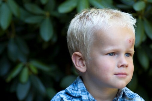 When To Call The Doctor After Your Child Hits Her Head1