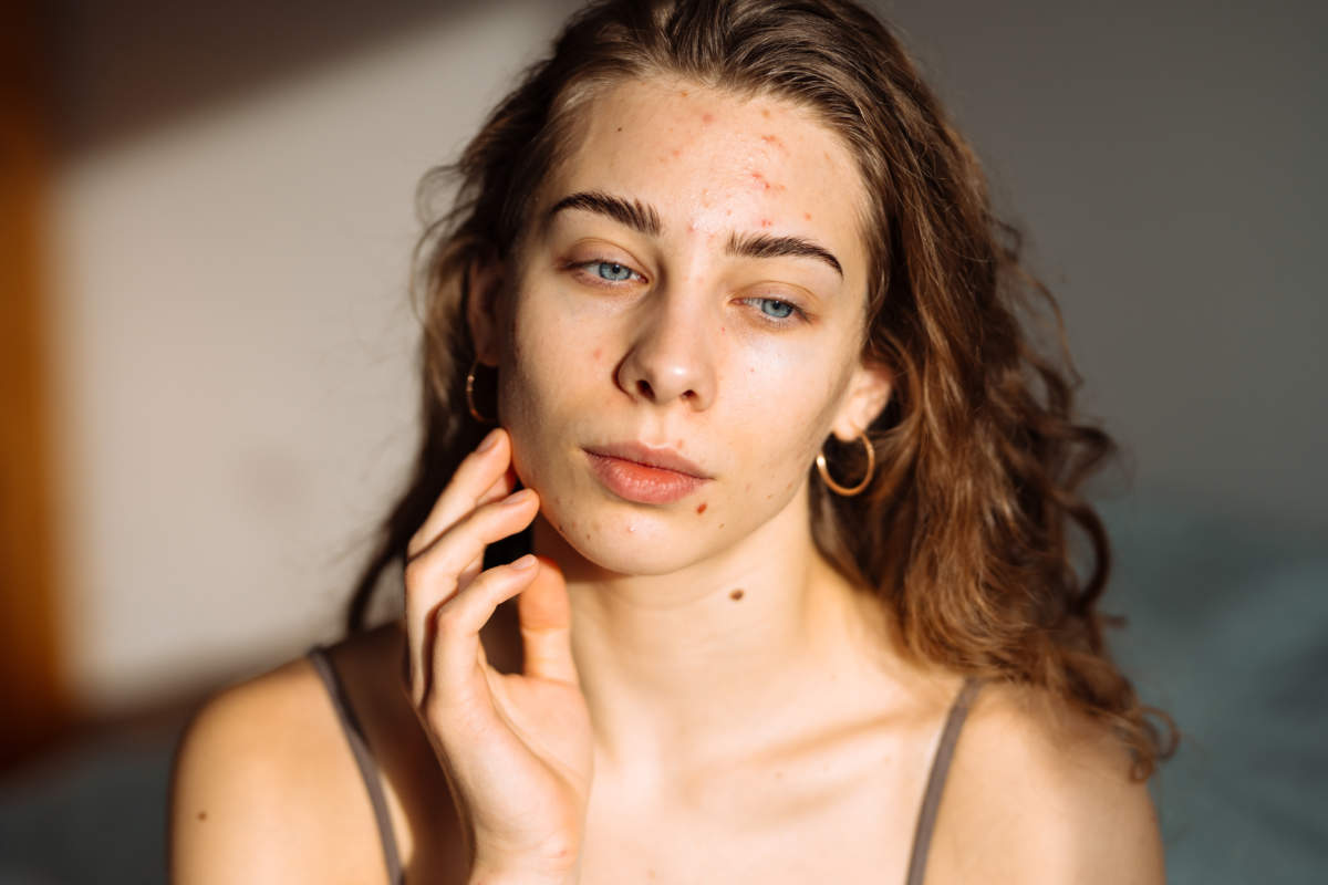 Young Woman With Acne Problem. Dermatology, Cosmetology, Skin Care. Natural Skin.
