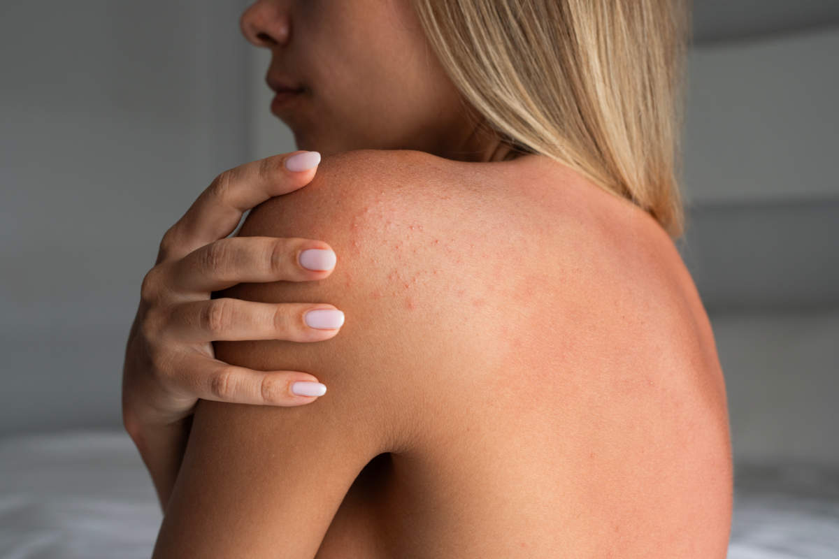 Young Woman Touching Shoulder With Small Red Bumps Caused By Sun Allergy. Close Up Of Irritated Skin On Back After Sun Exposure, Concept Of Uv Reaction, Sensitive Skin And Dermatology Problem